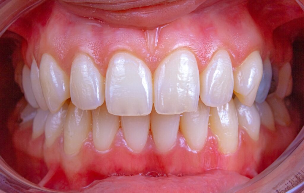 occlusione dentale come risolvere problema dentista bravo milano